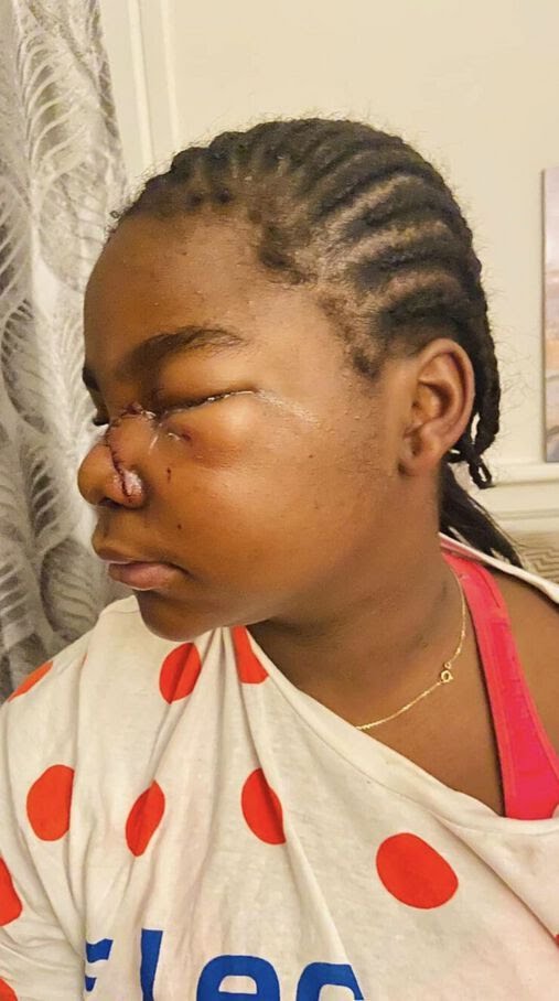 Victime de racisme une fillette noire de 11 ans a été gravement tabassée